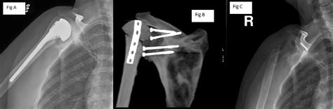 Resection Arthroplasty | Boston Shoulder Institute