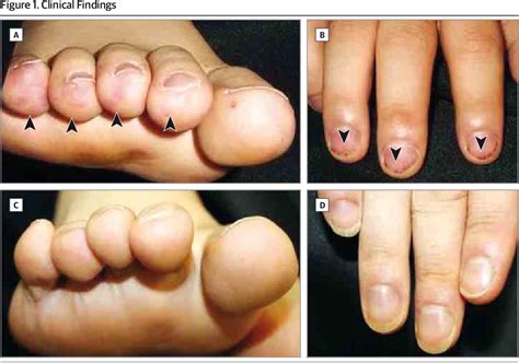 Figure 1 from Janeway Lesions and Splinter Hemorrhages in a PatientWith Eosinophilic ...