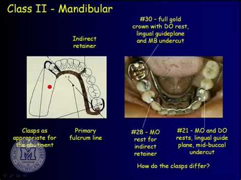 DENT 718: Removable partial dentures: design considerations - YouTube