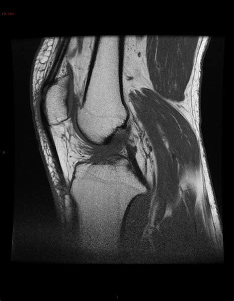 Posteromedial knee friction syndrome | Image | Radiopaedia.org