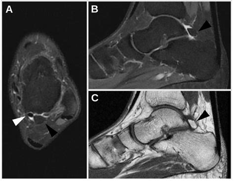 Os Trigonum Mri