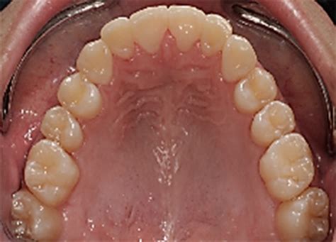 La Posición Estratégica de los Dientes Caninos – Sistema Gnático