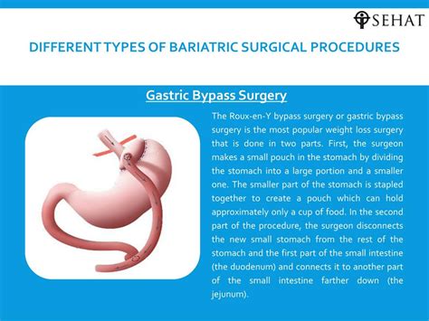 PPT - Bariatric surgery procedure PowerPoint Presentation, free download - ID:7365340