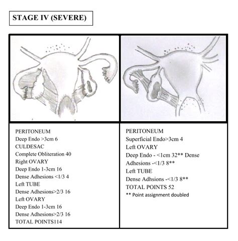 Types of Endometriosis | Staging of Endometriosis | PatientsEngage