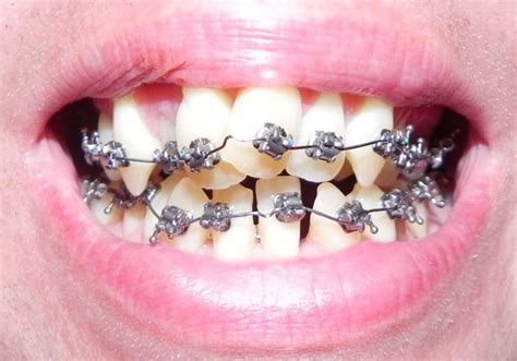 Risks of Do-It-Yourself Braces at HomeDr. Jacquie