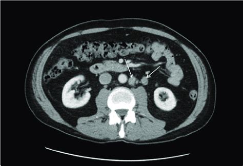 CT scan showed a few borderline enlarged lymph nodes in the... | Download Scientific Diagram