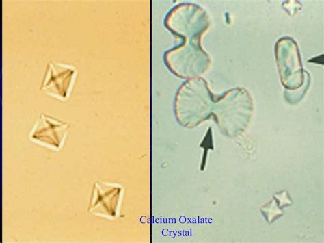 Sulfa Crystals In Urine | www.imgkid.com - The Image Kid Has It!