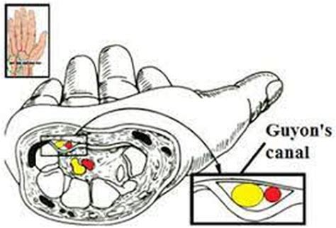 Risk Factors of Guyon’s Canal Syndrome - MEDizzy