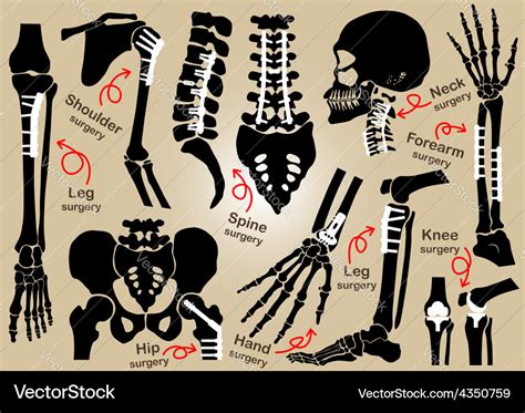 Collection of orthopedic surgery Royalty Free Vector Image