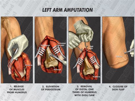 Left Arm Amputation | Medical Legal Illustration