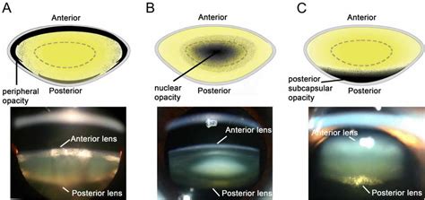 Cataracts Causes, Signs, Symptoms, Surgery, Recovery & Complications