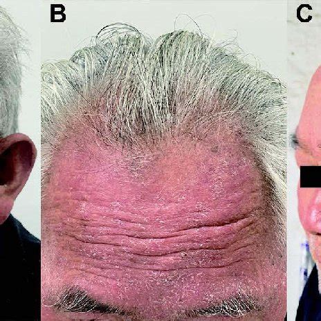 Erythematous-edematous and scaly rash on the face (A) and front... | Download Scientific Diagram