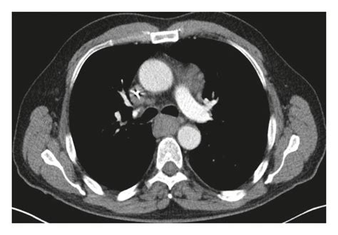 Computed tomography (CT) scan of the chest with contrast before and ...