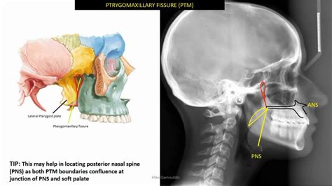 Pterygoid Plate Radiograph