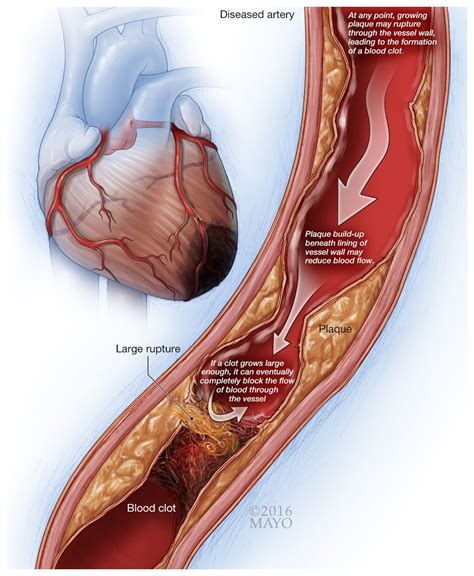 Cardiovascular Disease & Smoking | Guides & Tools | BecomeAnEX