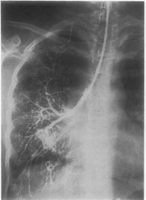 Right selective bronchogram in (a) the anteroposterior and (b) the... | Download Scientific Diagram