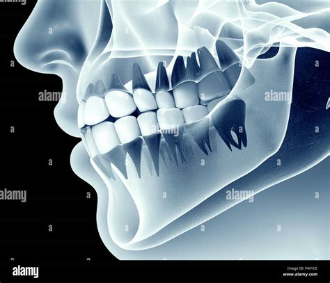 x-ray image of a jaw with teeth Stock Photo - Alamy