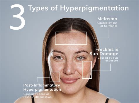 What is Hyperpigmentation All About? - DermPhysicians of New England