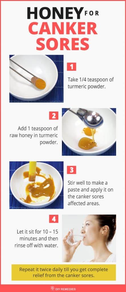 Home Remedies for Canker Sores
