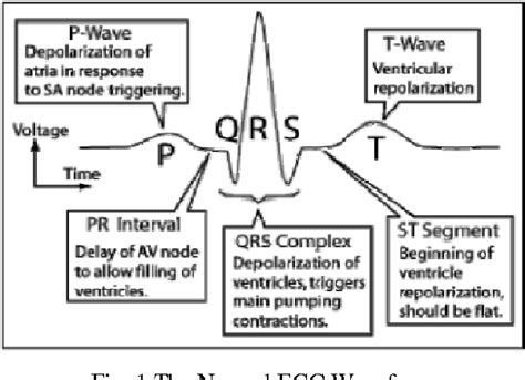 [PDF] Qrs Complex Detection of Ecg Signal Using Wavelet Transform ...