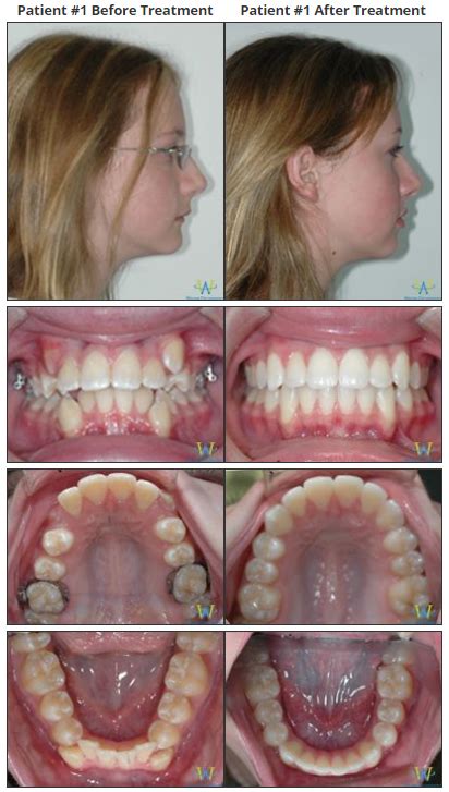 Braces Before And After Overbite