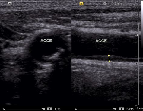 Carotid Doppler Ultrasound