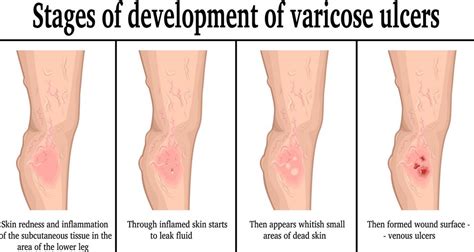 Bulging of veins in the leg can be an indication of Varicose Ulcer