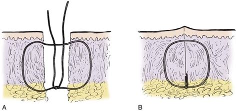 4: Wound Closure Techniques | Pocket Dentistry