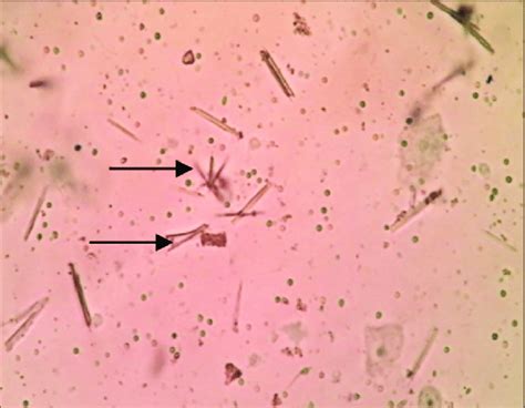 Calcium phosphate crystals from urine smear (arrows). | Download Scientific Diagram