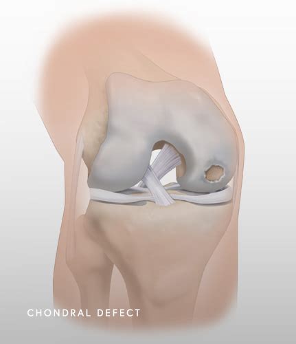 Chondral Defect Knee Chicago, IL | Dr. Jorge Chahla