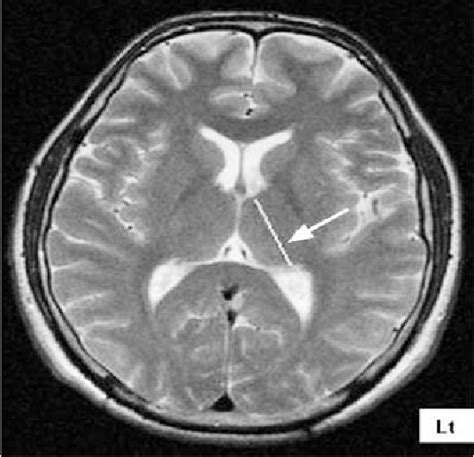 Morphometric measurements of the thalamus and interthalamic adhesion by MRI in the South-East of ...