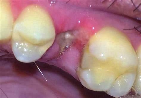 Swollen Gums From Wisdom Tooth | carfare.me 2019-2020