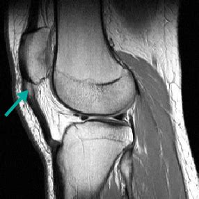 Patellar Tendinitis - Knee & Sports - Orthobullets