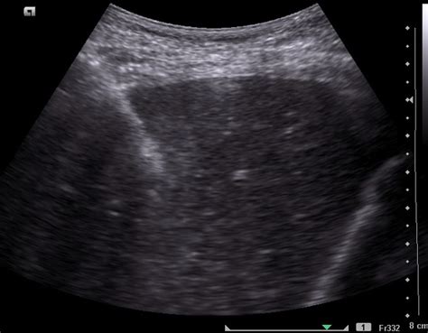 Liver biopsy (percutaneous) | pacs