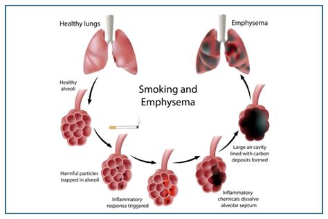 Emphysema: Causes, Symptoms, Complication, Treatment