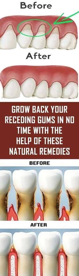 GROW BACK YOUR RECEDING GUMS WITH NATURAL REMEDIES