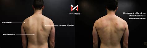 Winged Scapula and Shoulder Pain [Case Study] — ONI | Wellington Personal Training Studio