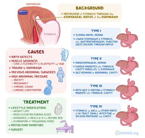 Hiatal Hernia: What Is It, Diagnosis, Treatment, and More | Osmosis