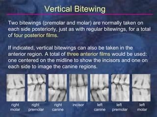 radiology-bitewing-technique | PPT