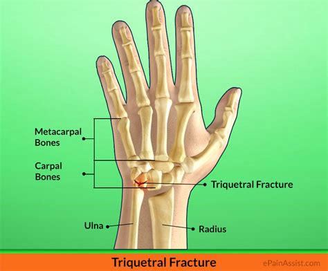 Triquetral Fracture: Treatment, Exercises, Causes, Symptoms, signs