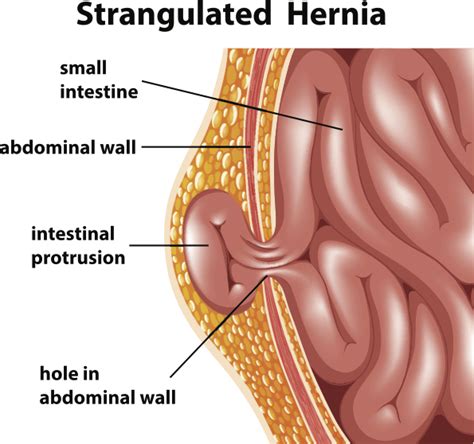 Inguinal/Groin Hernia - Upper East Side New York City, NY: New York Hernia Center: General Surgeon