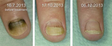 Figure 2 from Green Nail Syndrome (Pseudomonas aeruginosa Nail Infection): Two Cases ...