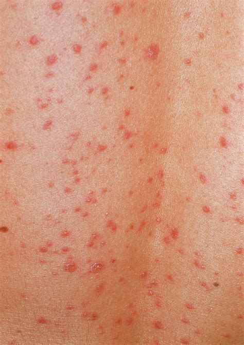 Guttate Psoriasis Skin Rash Photograph by Science Photo Library - Pixels