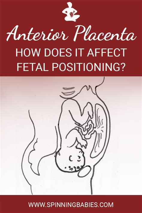 Anterior Placenta - What It Means for You and Your Baby - Spinning Babies | Anterior placenta ...