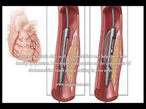 Removing Plaque From Coronary Artery, How To Remove Plaque From Coronary Artery Naturally - YouTube