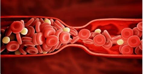 Anesthesiology and Intensive Care: Contraindications to Fibrinolytic Therapy in Patients with STEMI