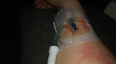 Rituxan infusion successful | Multiple experienceS