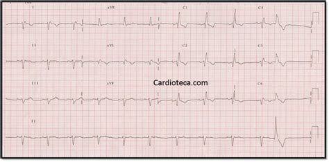 Curso ECG: Dextrocardia