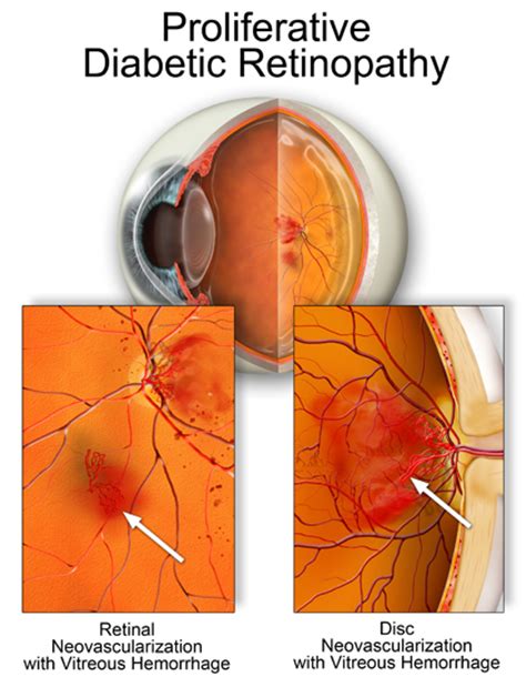 DIABETIC RETINOPATHY | Optometry Today