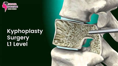 Kyphoplasty Surgery L1 Level | Spine surgery, Spinal fusion surgery, Surgery